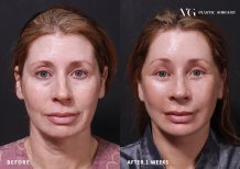 Vorher-nachher-Ergebnis Stirnlifting bei VG Plastic Surgery – sichtbare Verjüngung der Stirn