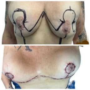 Before and after breast reduction results at Hospital de la Familia, improved breast contour
