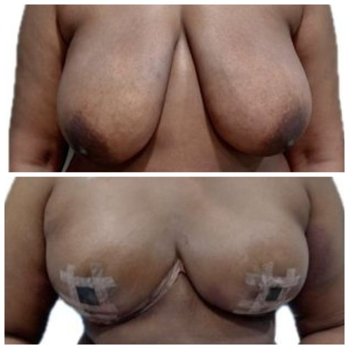 Before and after breast reduction results at Hospital de la Familia, improved breast shape