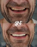 Vorher-nachher-Zirkon-Kronen bei Nifa Dent International – Smile-Design-Ergebnis
