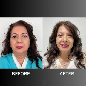 Before and after facelift results at ID Clinic Bangkok, visible facial rejuvenation and lift