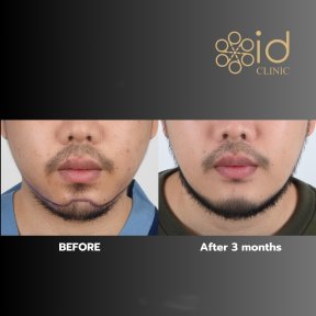 Chin liposuction before and after results at ID Clinic Bangkok, improved jawline after 3 months