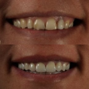 Before and after zirconia crown results at Grand Dental Hospital & Laboratory, smile restoration