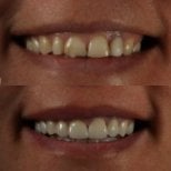 Before and after zirconia crown results at Grand Dental Hospital & Laboratory, smile restoration