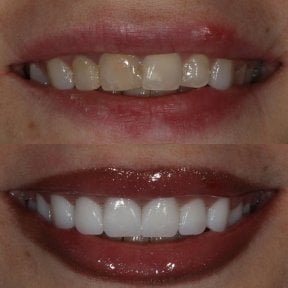 Before and after zirconia crown results at Grand Dental Hospital & Laboratory, smile makeover