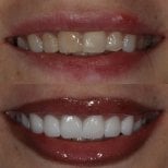 Before and after zirconia crown results at Grand Dental Hospital & Laboratory, smile makeover