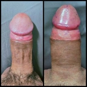 Результаты до и после хирургического удлинения пениса в Eternity Clinic Pleonchit Branche