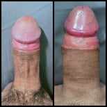 Результаты до и после хирургического удлинения пениса в Eternity Clinic Pleonchit Branche