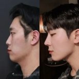 Результат до и после гениопластики в VG Plastic Surgery – улучшенный контур подбородка