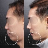 Результат до и после гениопластики в VG Plastic Surgery, улучшенный контур подбородка