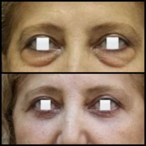 Vorher-nachher-Ergebnisse der Blepharoplastik bei Assoc.Prof.Dr.Cemal Kara / Medical Park İzmir Hospital