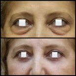 Vorher-nachher-Ergebnisse der Blepharoplastik bei Assoc.Prof.Dr.Cemal Kara / Medical Park İzmir Hospital