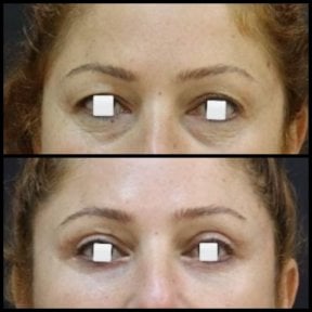 Vorher-nachher-Ergebnisse der Blepharoplastik bei Assoc.Prof.Dr.Cemal Kara / Medical Park İzmir Hospital