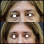 Vorher-nachher-Ergebnisse der Blepharoplastik bei Assoc.Prof.Dr.Cemal Kara / Medical Park İzmir Hospital