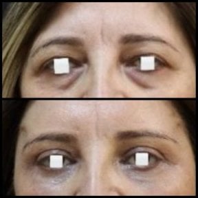 Vorher-nachher-Ergebnisse der Blepharoplastik bei Assoc.Prof.Dr.Cemal Kara / Medical Park İzmir