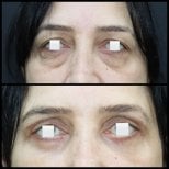 Vorher-nachher-Ergebnisse der Blepharoplastik bei Assoc.Prof.Dr.Cemal Kara / Medical Park İzmir Hospital