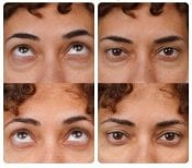 Résultats avant et après blépharoplastie chez Yurchenko Plastic Surgery Team, correction des paupières
