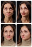 Blepharoplasty before and after results at Yurchenko Plastic Surgery Team, eyelid correction