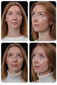 Blepharoplasty before and after results at Yurchenko Plastic Surgery Team, eyelid correction