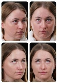 Résultats avant/après blépharoplastie chez Yurchenko Plastic Surgery Team, correction des paupières