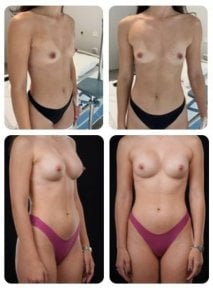 Результати до і після збільшення грудей у Yurchenko Plastic Surgery Team Kyiv, природний вигляд