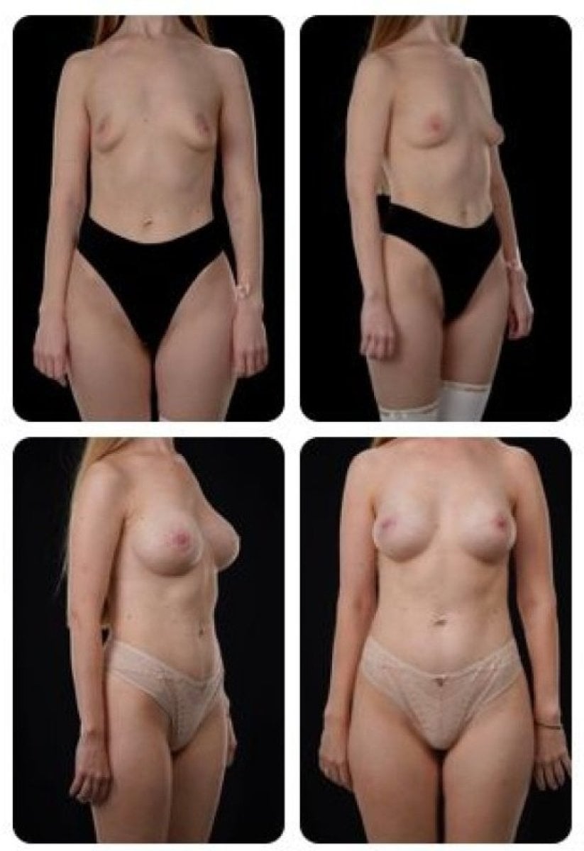 نتائج تكبير الثدي قبل وبعد في Yurchenko Plastic Surgery Team Kyiv، صدر أكثر امتلاءً