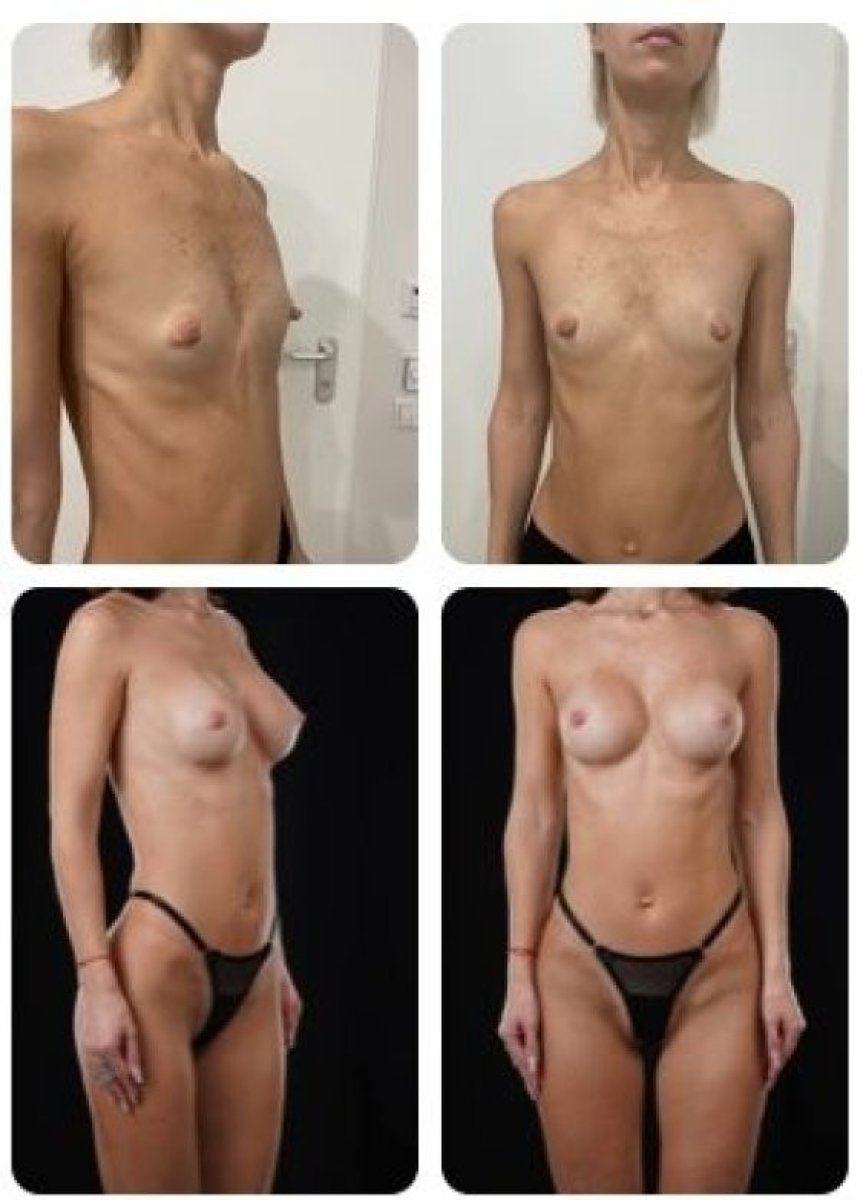 نتائج قبل وبعد تكبير الثدي في عيادة Yurchenko Plastic Surgery Team Kyiv