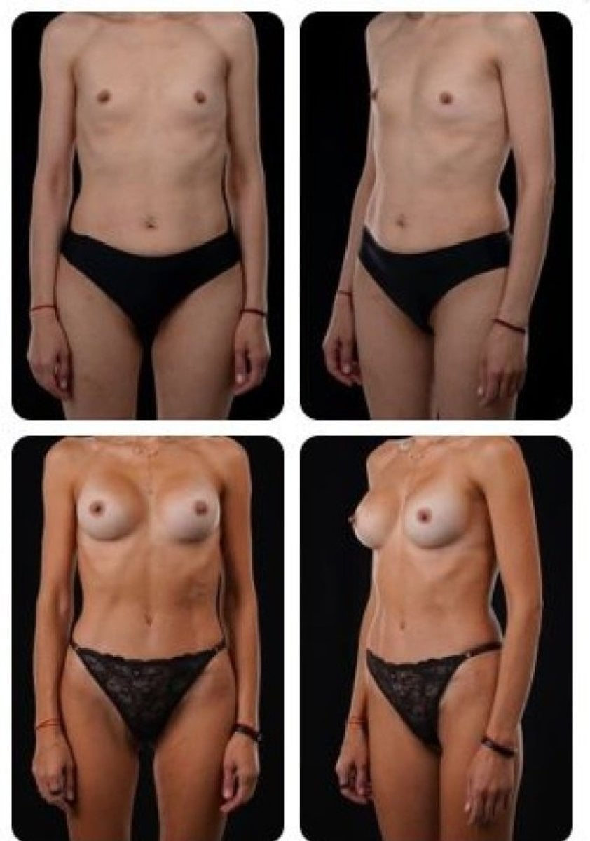 نتائج قبل وبعد تكبير الثدي في عيادة Yurchenko Plastic Surgery Team Kyiv