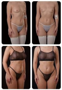 Vorher-nachher-Ergebnisse Brustvergrößerung bei Yurchenko Plastic Surgery Team Kiew