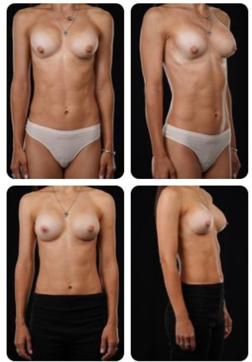 نتائج قبل وبعد تكبير الثدي في Yurchenko Plastic Surgery Team Kyiv، صدر أكثر امتلاءً