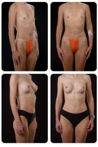 نتائج قبل وبعد تكبير الثدي في عيادة Yurchenko Plastic Surgery Team Kyiv