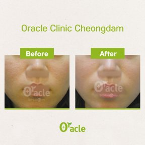Результаты до и после Ultherapy в Oracle Clinic Cheongdam, эффект подтяжки кожи лица