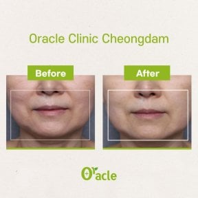 Результаты до и после Ultherapy в Oracle Clinic Cheongdam, видимый лифтинг кожи лица
