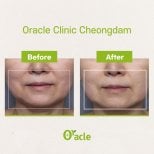 Результаты до и после Ultherapy в Oracle Clinic Cheongdam, видимый лифтинг кожи лица