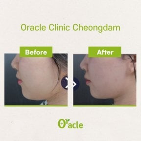 Результаты до и после ультерапии в Oracle Clinic Cheongdam, улучшение контура лица
