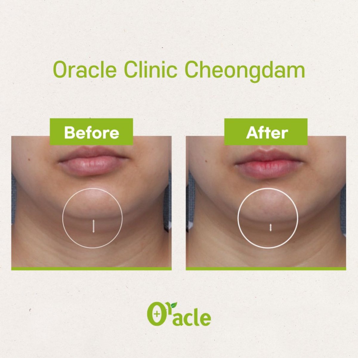 Resultados de Ultherapy antes y después en Oracle Clinic Cheongdam, reafirmación visible de la mandíbula