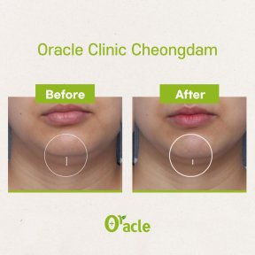 Результаты до и после Ultherapy в Oracle Clinic Cheongdam, видимое подтяжка линии подбородка