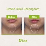 Результаты до и после Ultherapy в Oracle Clinic Cheongdam, видимое подтяжка линии подбородка