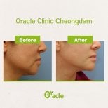 Результаты до и после ультерапии в Oracle Clinic Cheongdam, видимое подтяжка кожи лица