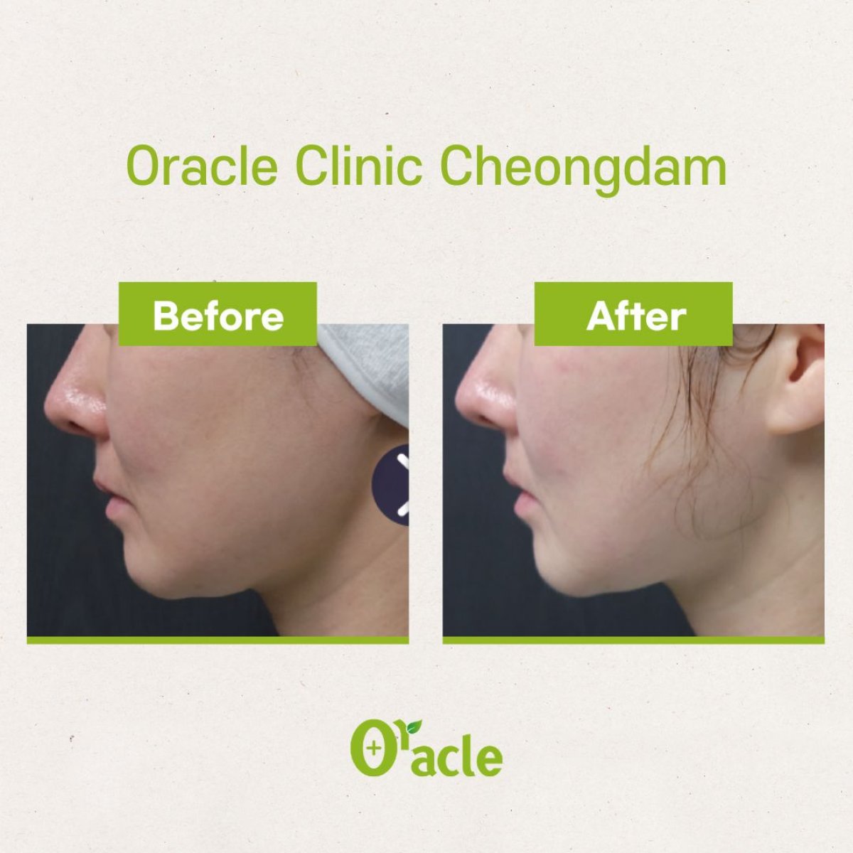 نتائج قبل وبعد علاج Ultherapy في Oracle Clinic Cheongdam، شد واضح للبشرة