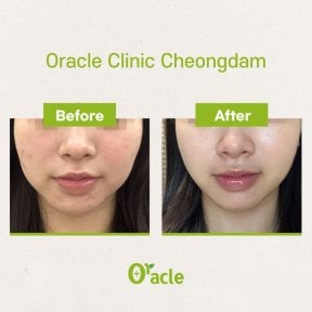 Результаты до и после ультерапии в Oracle Clinic Cheongdam, улучшение упругости кожи лица
