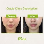 Результаты до и после ультерапии в Oracle Clinic Cheongdam, улучшение упругости кожи лица