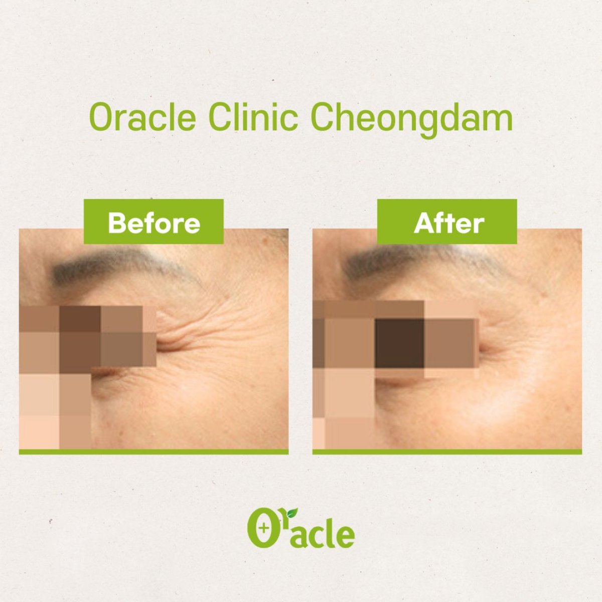 Resultados antes y después de Thermage para arrugas de ojos en Oracle Clinic Cheongdam