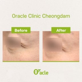 Vorher-nachher-Ergebnis Thermage Augenfalten bei Oracle Clinic Cheongdam
