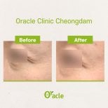 Vorher-nachher-Ergebnis Thermage Augenfalten bei Oracle Clinic Cheongdam