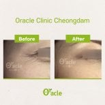 Résultats Thermage contour des yeux avant et après à Oracle Clinic Cheongdam, rides réduites