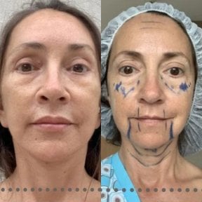 Deep plane facelift preparation at Memorial Ataşehir Hospital, facial contouring procedure result