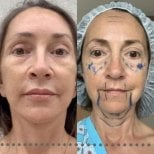 Deep plane facelift preparation at Memorial Ataşehir Hospital, facial contouring procedure result