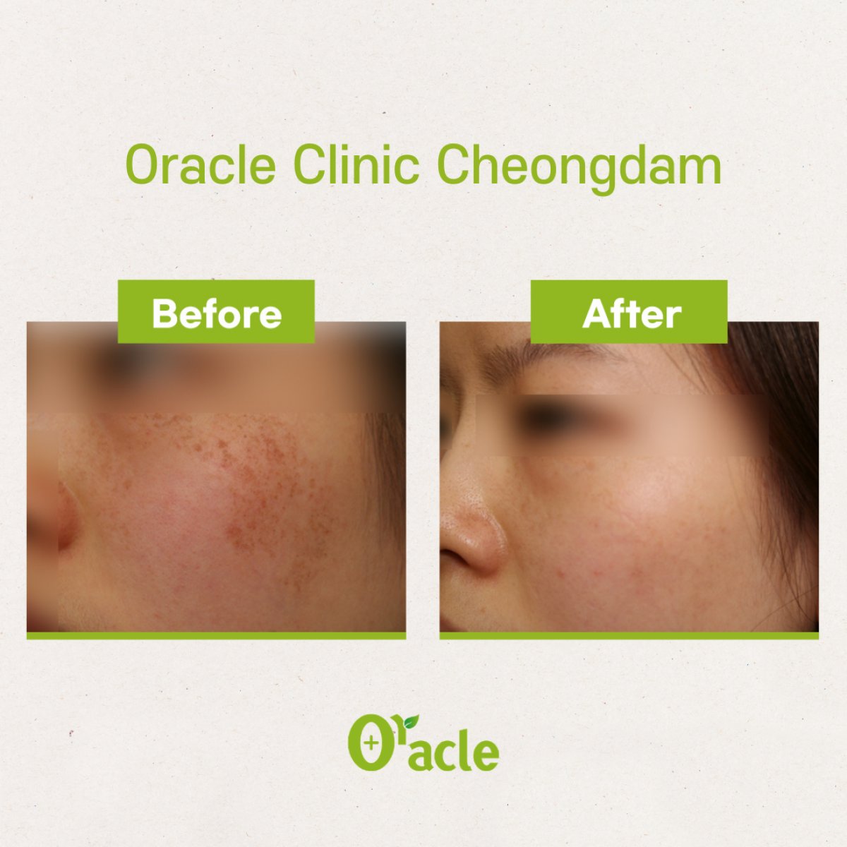 نتائج ثيرماج قبل وبعد في Oracle Clinic Cheongdam، تحسين ملمس بشرة الوجه