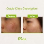 Résultats Thermage avant et après à Oracle Clinic Cheongdam, texture de peau améliorée
